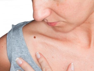 El cáncer de piel es el tipo de cáncer más común en los Estados Unidos. En el 2009, 61,646 personas en los Estados Unidos recibieron un diagnóstico de melanomas en la piel y 9,199 murieron por esta enfermedad.