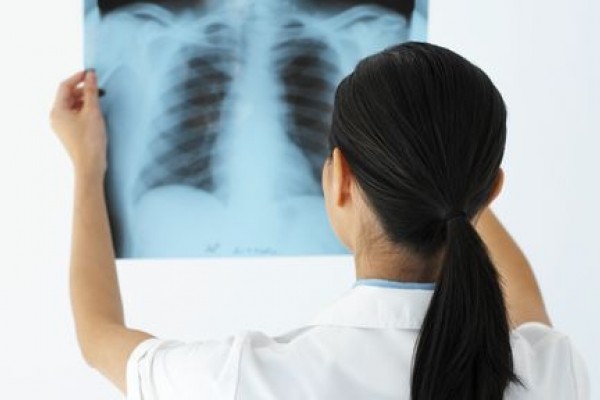 El cáncer de pulmón y los hispanos: preguntas y respuestas El cáncer de pulmón y los hispanos: preguntas y respuestas