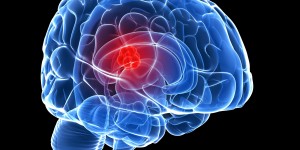 “Los tumores en el cerebro son de los más agresivos y durante los últimos 30 años, ha habido poco éxito en la búsqueda de tratamientos que aumenten la esperanza de vida de los pacientes, –comentó el Dr. Nader Sanai, Director del Centro de Investigaciones de Tumores Cerebrales de Barrow–. Este método de Fase 0 para tumores cerebrales malignos cambia las reglas del juego en las investigaciones del cáncer y nuestro programa es el primero en su clase en todo el mundo”.