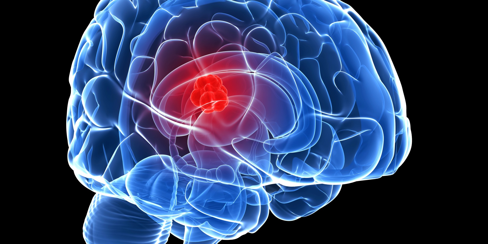 “Pruebas de Fase 0”, cambian las reglas del juego en cuanto a tratamiento para combatir tumores cerebrales “Pruebas de Fase 0”, cambian las reglas del juego en cuanto a tratamiento para combatir tumores cerebrales