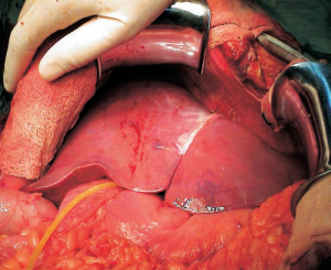 Imagen de un hígado transplantado. Actualmente, mas de 2,000 personas en Arizona esperan trasplantes de órganos, de las cuales, más de 450 necesitan trasplante de hígado. Un donante de órganos puede salvar hasta ocho vidas. Los habitantes de Arizona pueden registrarse para ser donantes de órganos y tejidos en www.DonateLifeAZ.org.