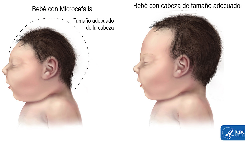 “Esta es la noticia que temíamos”: March of Dimes reacciona a los informes sobre casos locales de Zika en la Florida