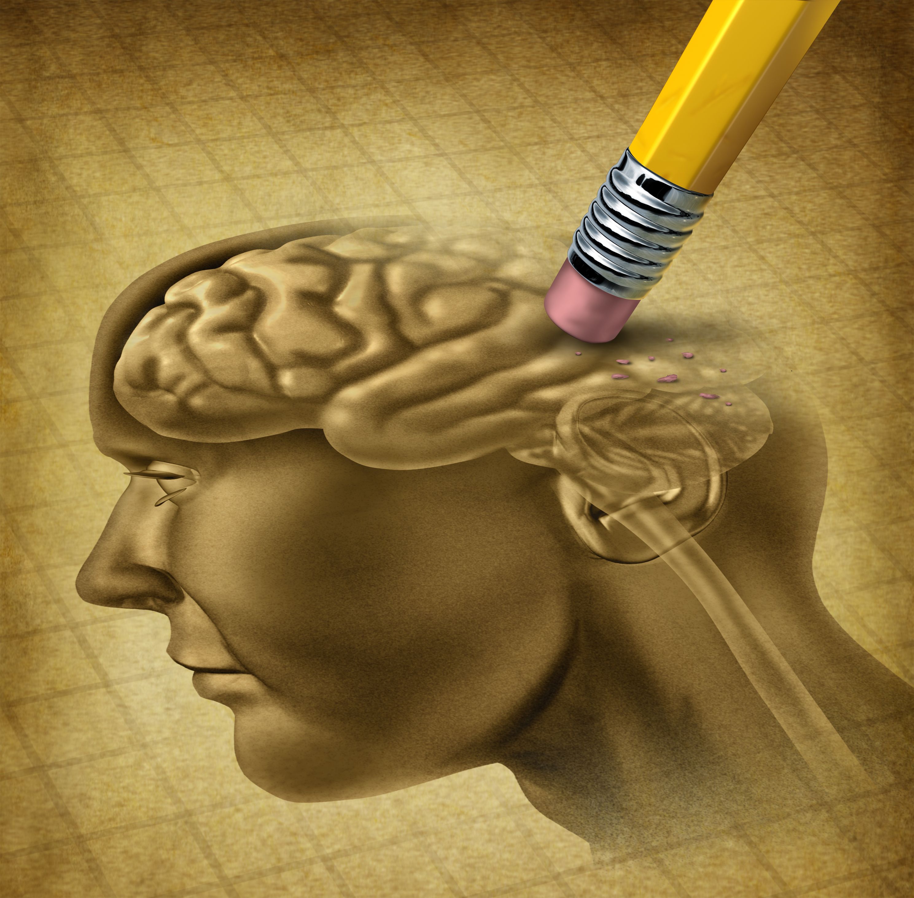 Nueva droga en estudio podría retardar la progresión de la enfermedad de Alzheimer Nueva droga en estudio podría retardar la progresión de la enfermedad de Alzheimer